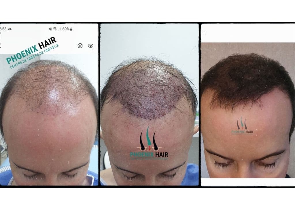 Progression greffe FUE suivi clinique — Phoenix Hair Center