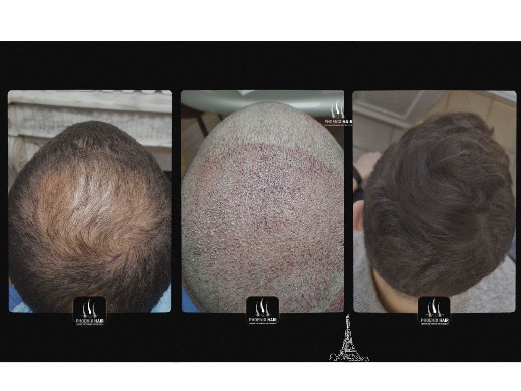 Greffe cheveux FUE - Résultat vertex