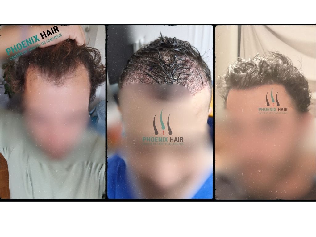 Greffe cheveux FUE - Résultat densité