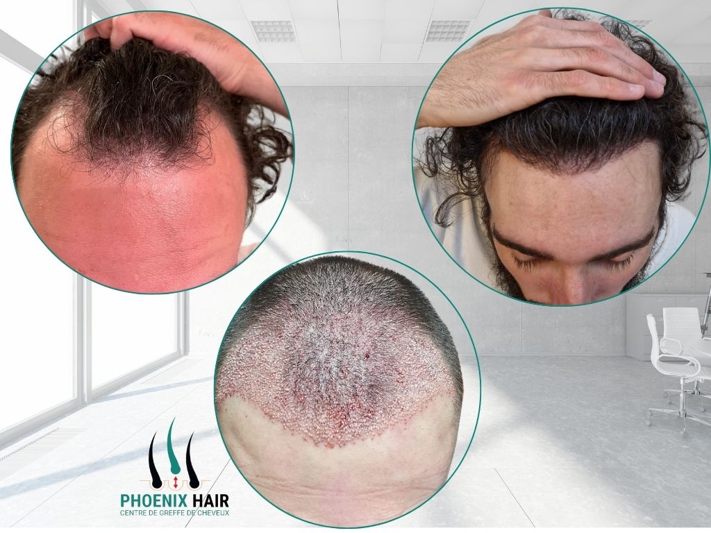 Greffe cheveux FUE - Avant et après intervention