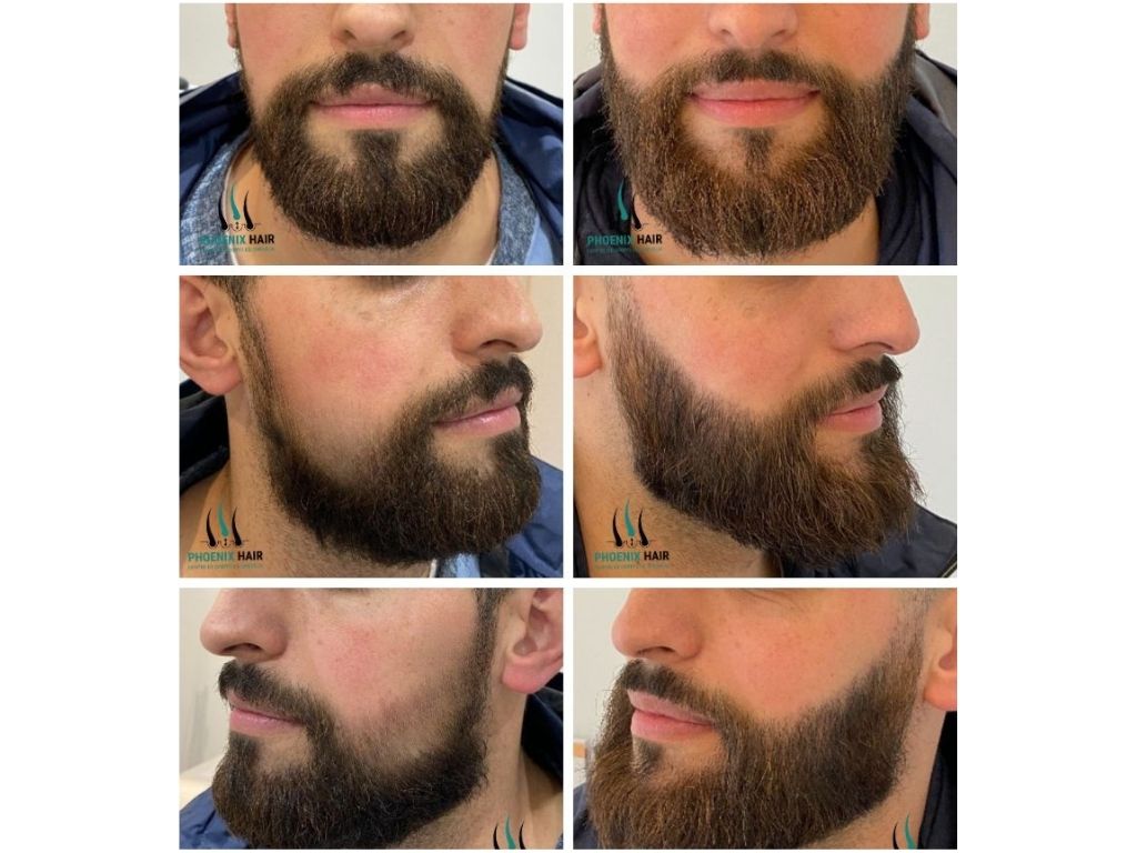 Greffe barbe FUE - Résultats détaillés