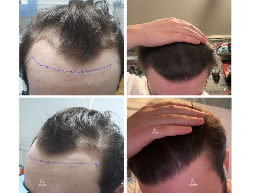Greffe cheveux FUE - Résultat ligne frontale homme