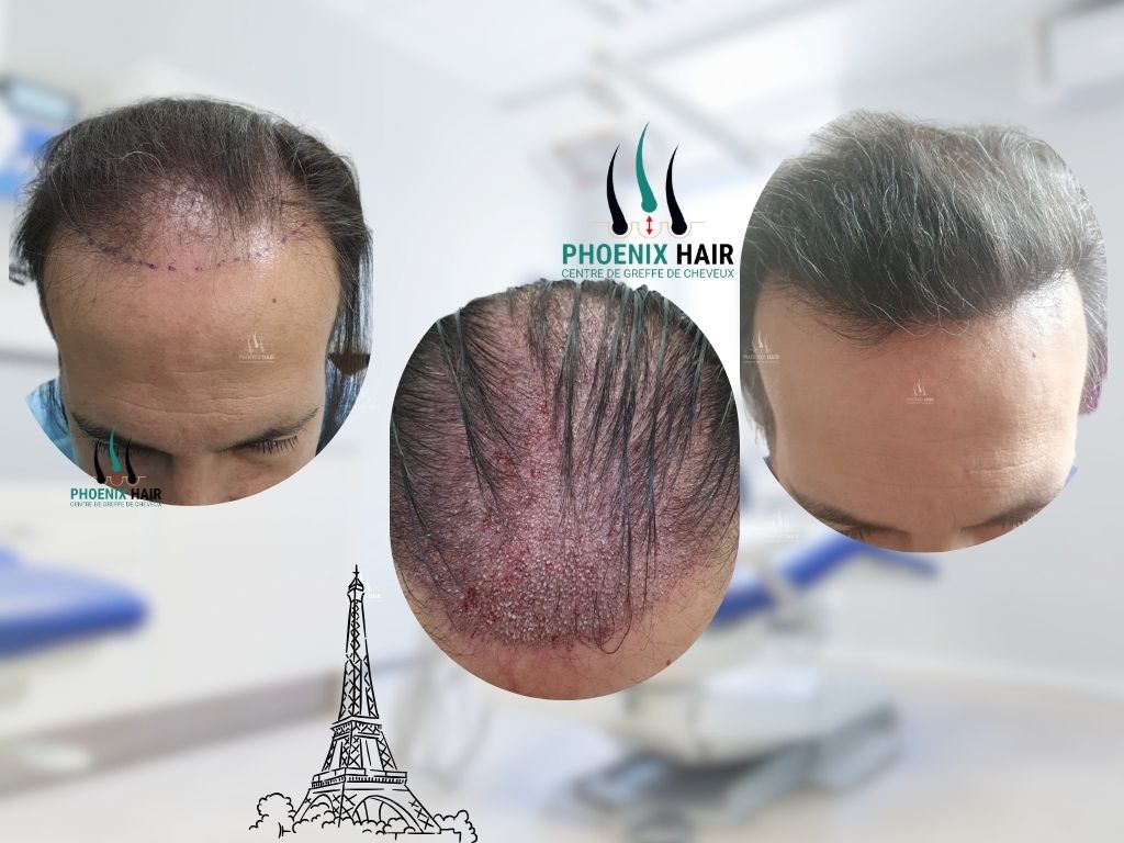 Greffe cheveux FUE - Résultat frontale et vertex