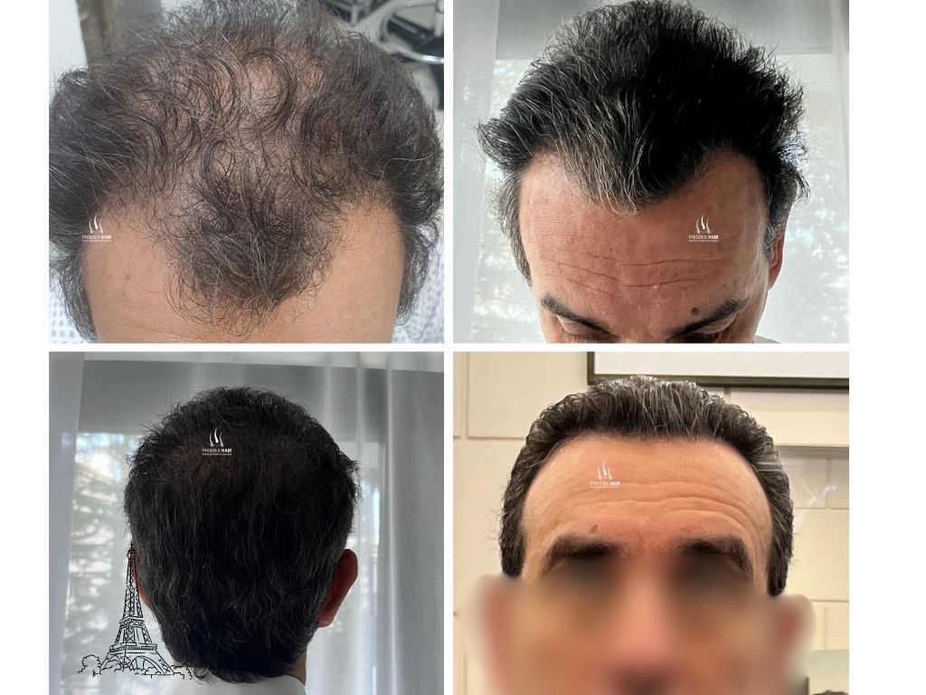 Greffe cheveux FUE - Transformation complète