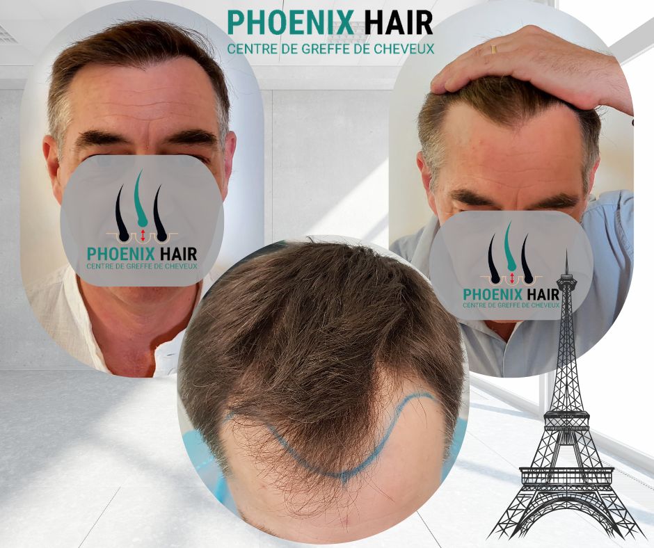 Greffe cheveux FUE - Résultat densification