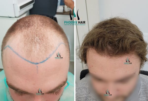 Greffe cheveux FUE - Résultat ligne frontale jeune homme