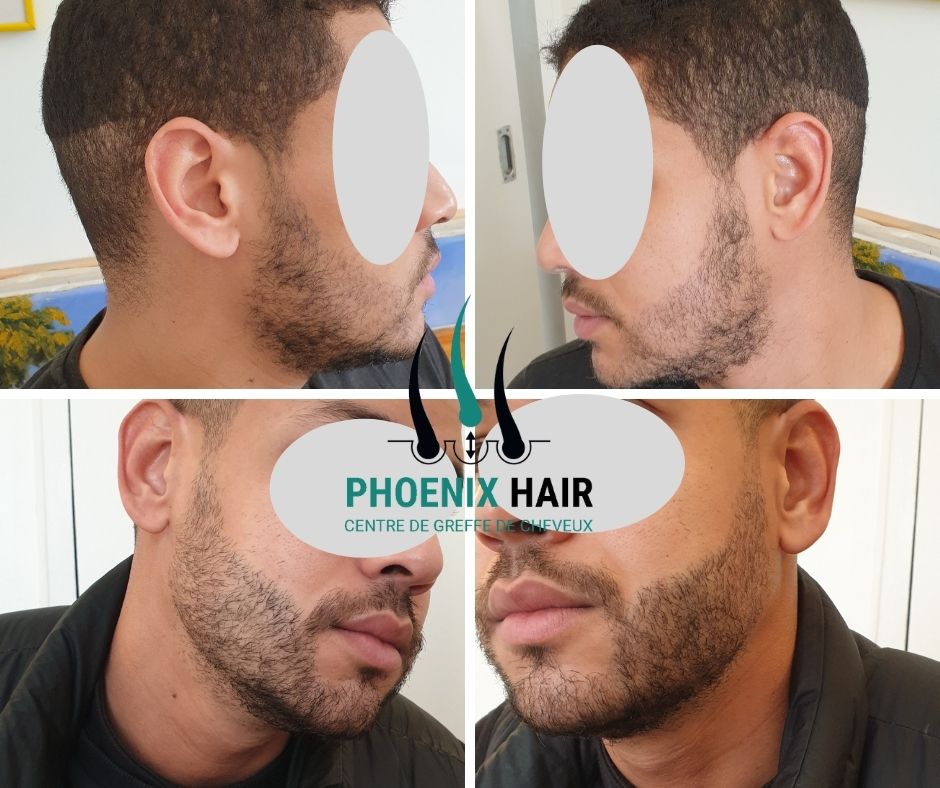 Greffe cheveux FUE - Résultat naturel après intervention